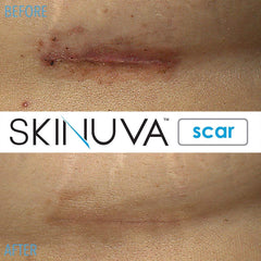 Skinuva packaging box front showcases premium scar treatment product