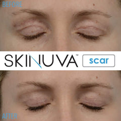 Skinnuva scar treatment routine image emphasizing consistency.