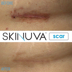 Silicone-based layer from Skinuva for barrier support.
