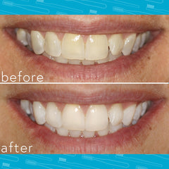 Smileactives whitening gel close-up showing hydrogen peroxide action