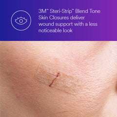 Steri-Strip Blend Tone on the face blends with skin.