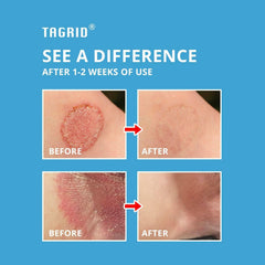 Cooling effect of TAGRID cream on itchy skin.