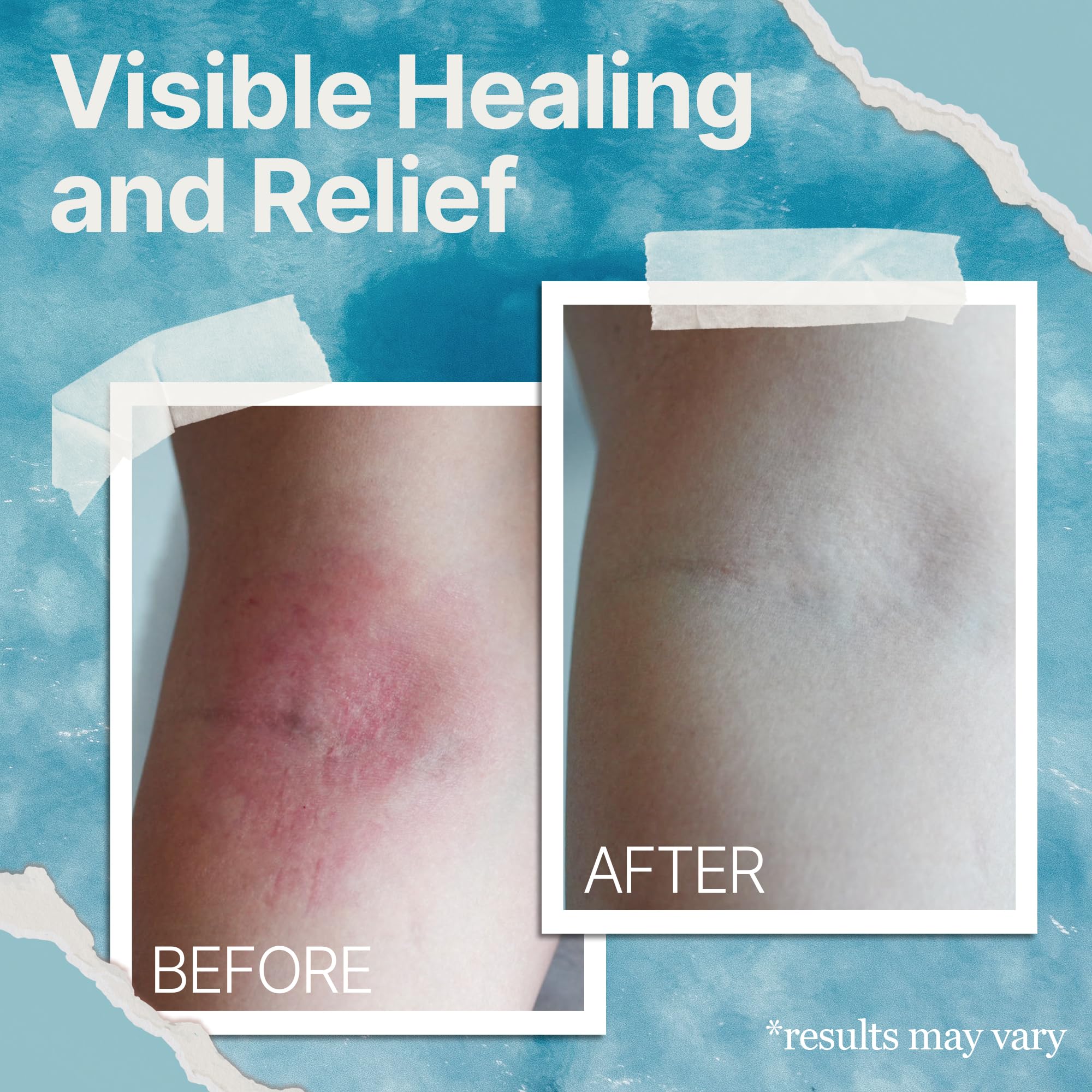 The Ocean Healed My Eczema hand application shows easy daily use