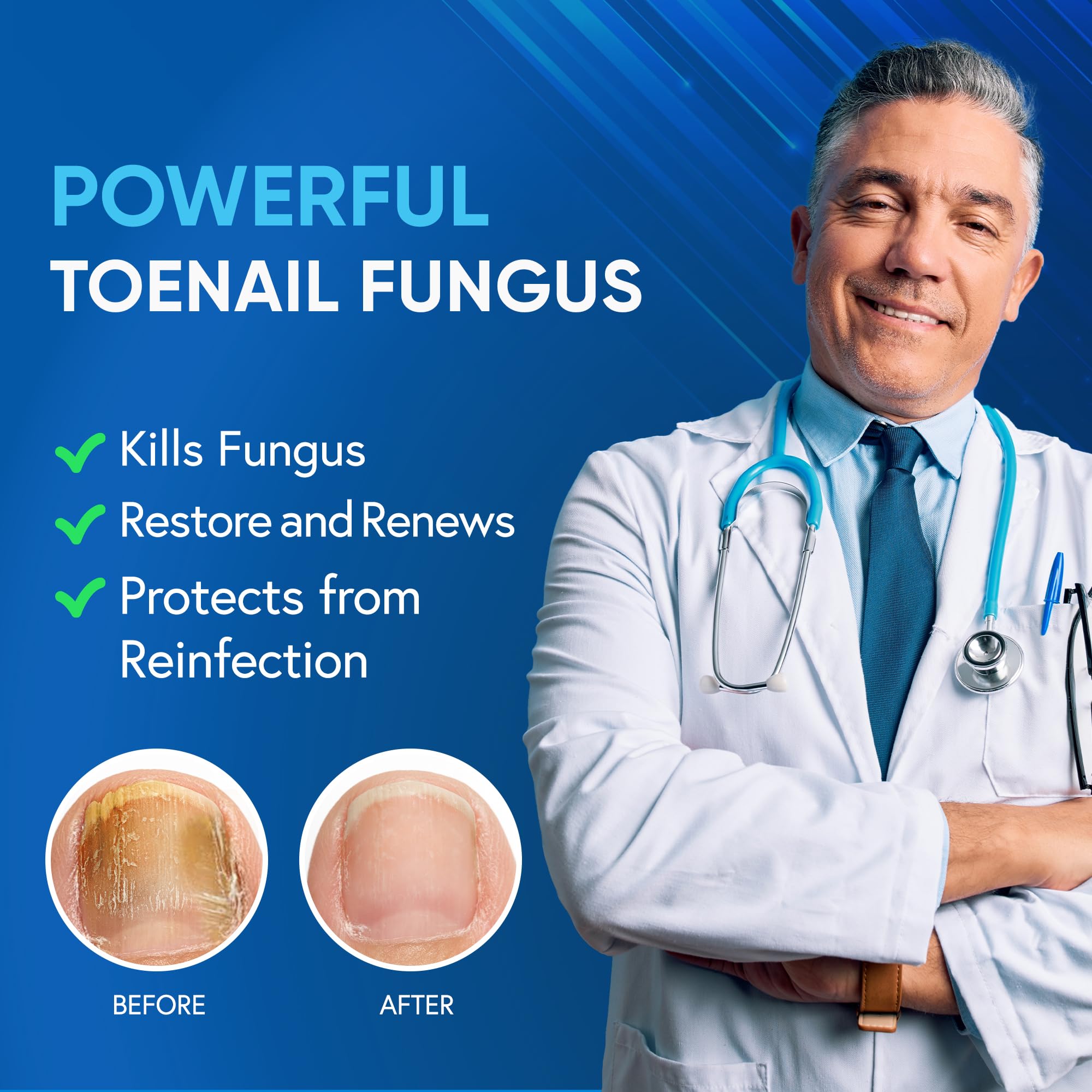 Tobcharm 25 percent undecylenic acid bottle for targeted nail care.