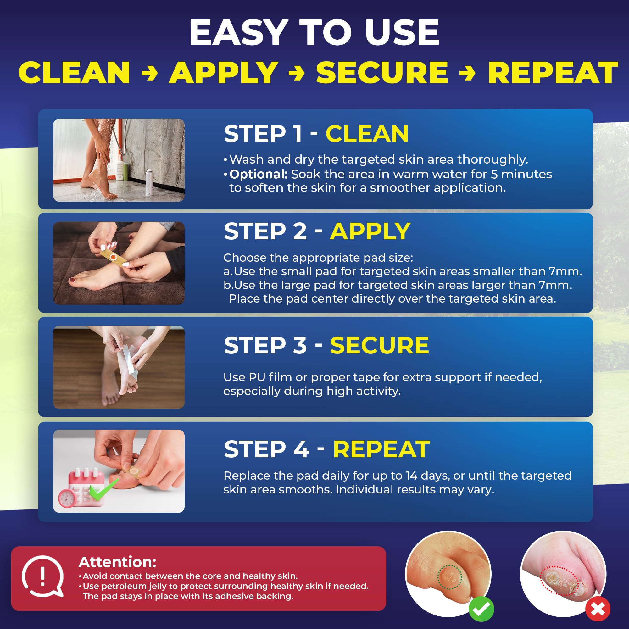 Ulensy pad placed on the sole to ease walking discomfort