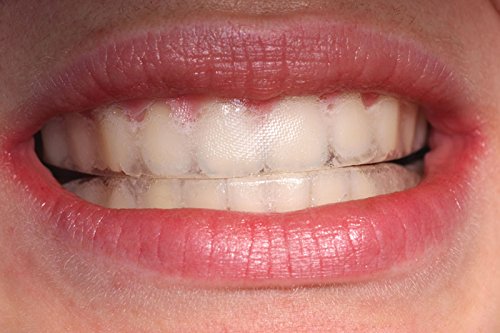 Ultra White video instructions show proper tray formation guidance for at-home whitening.
