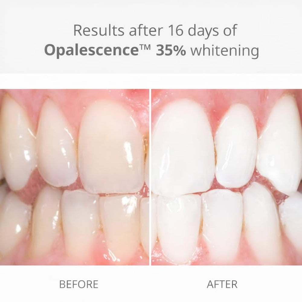 Ultradent Opalescence 35% gel close-up showing precise syringe delivery