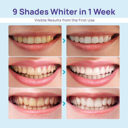Whitebite Pro dual LED in operation for faster stain reduction at home.