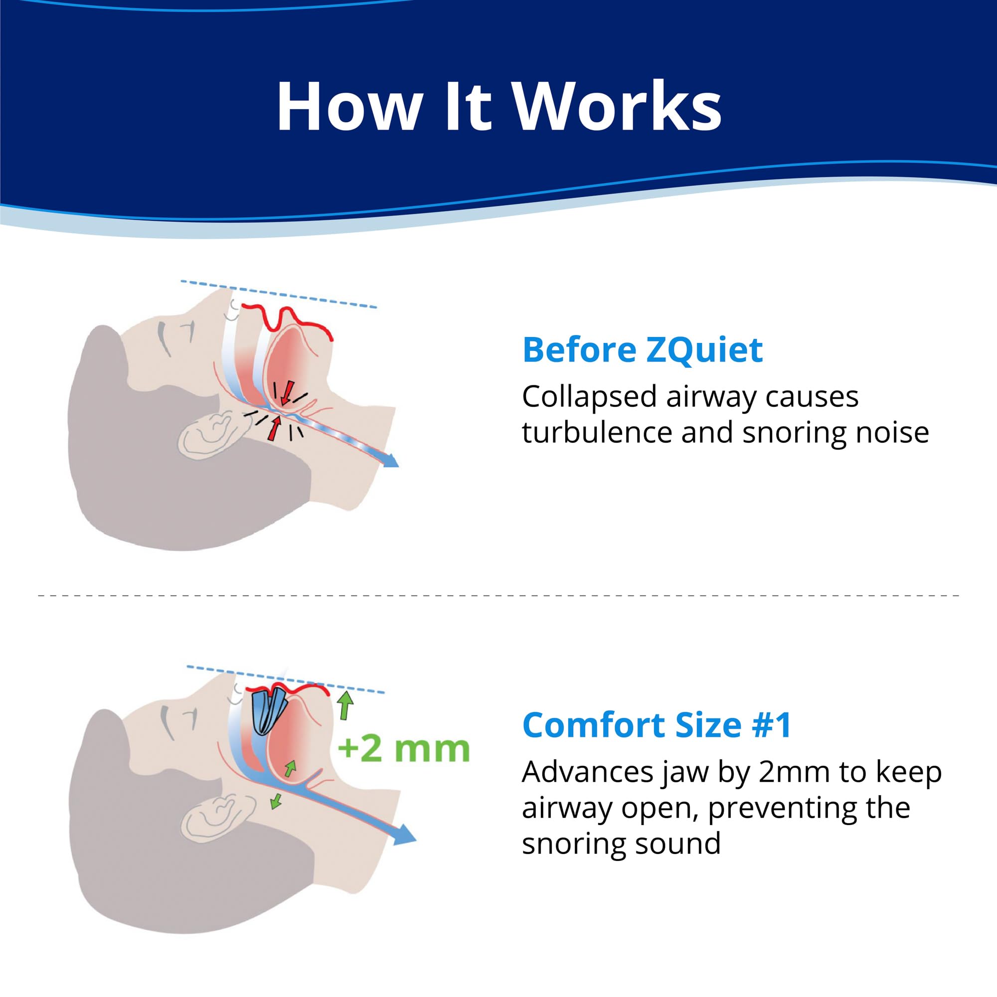 ZQuiet comfort size 1 mouthpiece side view showing slim profile for easy wear.