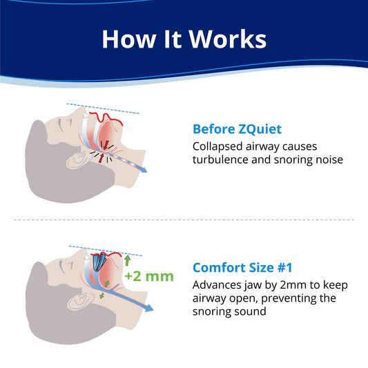 ZQuiet comfort size 1 mouthpiece side view showing slim profile for easy wear.