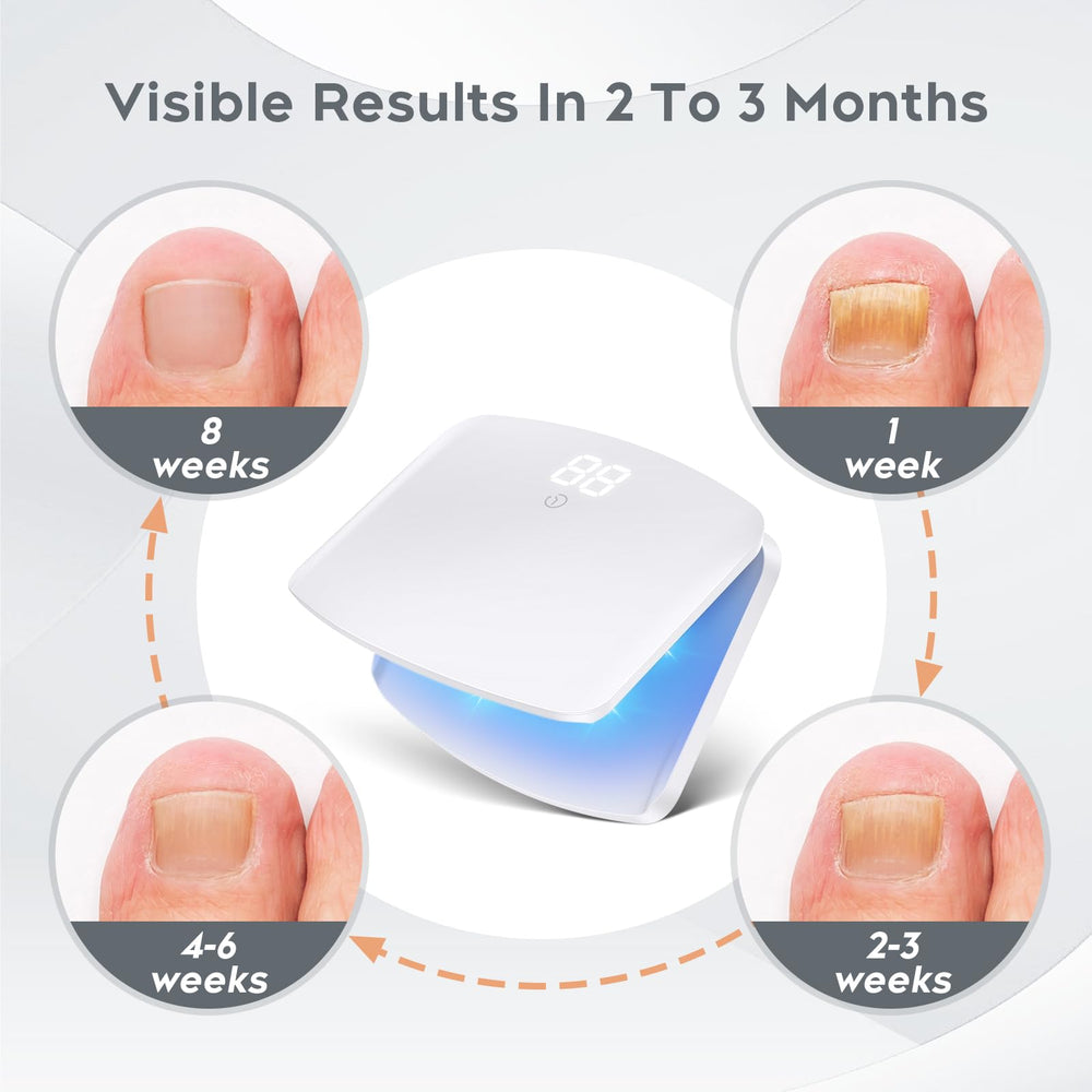 ZZP Nail Fungus Light Device during use demonstrates targeted light therapy session
